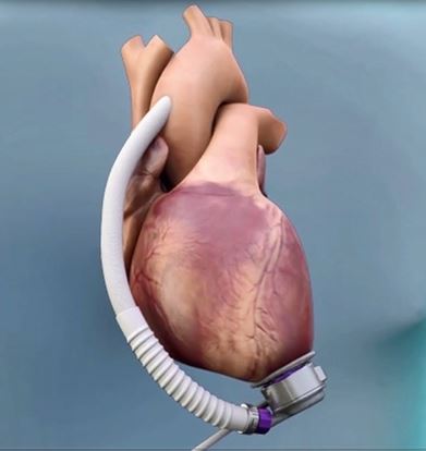 В Россию пришла инновационная технология HeartMate3 компании Abbott – альтернатива пересадке сердца для пациентов с тяжелой сердечной недостаточностью