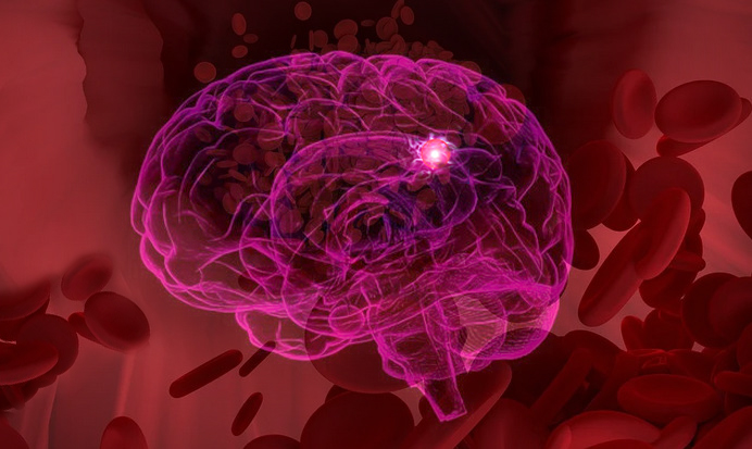 Сетчатый стент – новая возможность лечения сложных аневризм