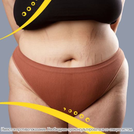 Растяжки при похудении