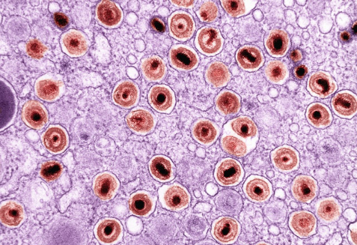 Мукополисахаридоз