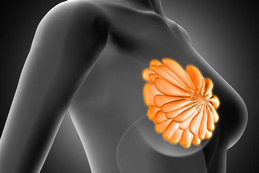 Рак молочной железы