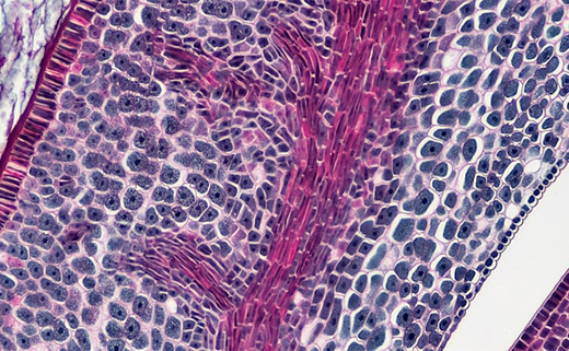 Атеросклероз сосудов