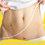 Шрам от аппендицита