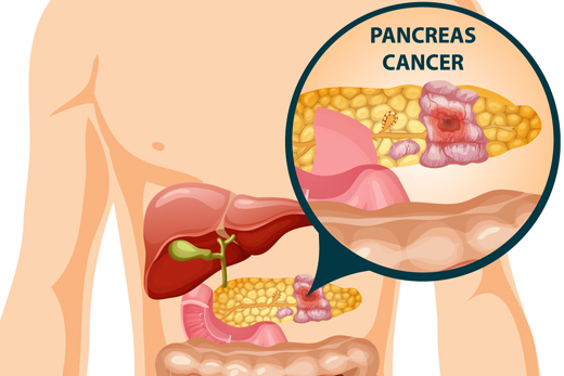 FDA одобрило первое в своем классе устройство для лечения рака поджелудочной железы