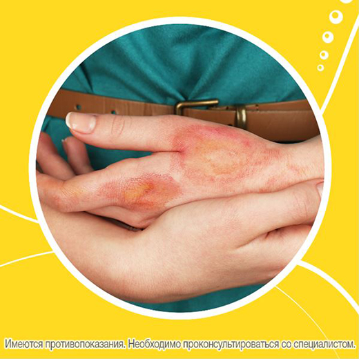 Ожог кипятком